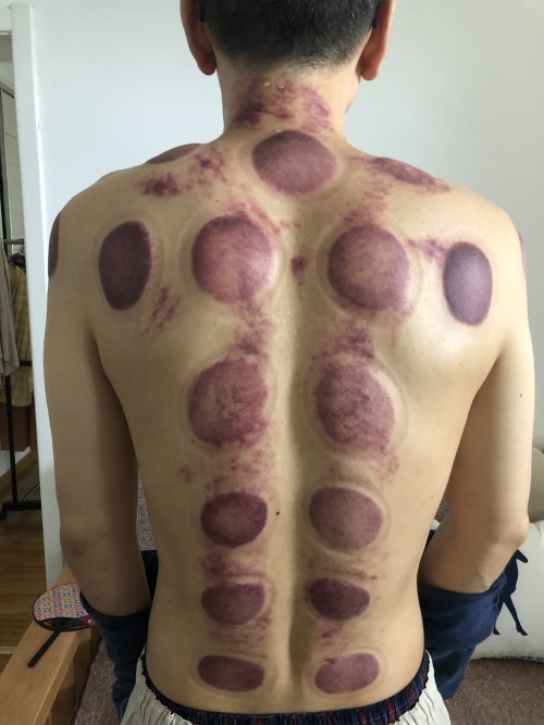 グァシャ  吸い玉